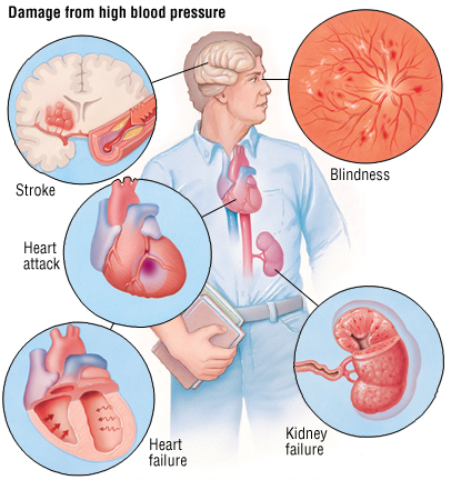 Bệnh tăng huyết áp dễ gây ra nhồi máu cơ tim, tai biến mạch máu não, biến chứng về thận, mắt, tử vong.