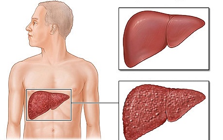 Một số thuốc rất độc với gan, gây nên các bệnh gan mạn tính.