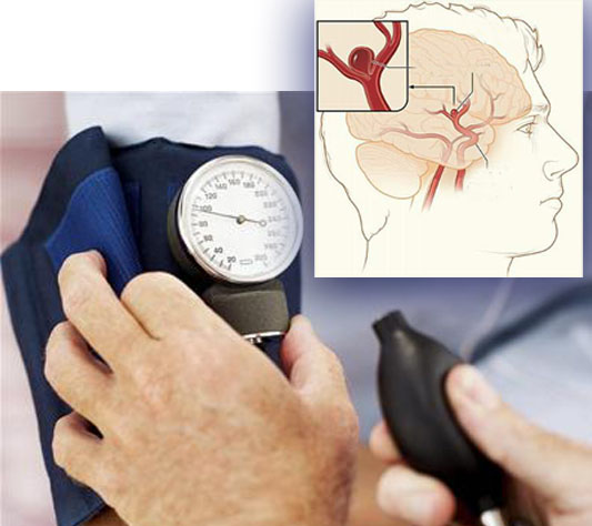 Tăng huyết áp gây phình động mạch não.