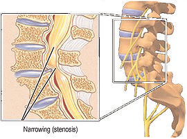 Ống sống bị hẹp (hình trái)