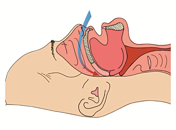 Phần mô mềm: lưỡi và sụn bị tụt vào trong đường thở gây tắc nghẽn lưu lượng khí