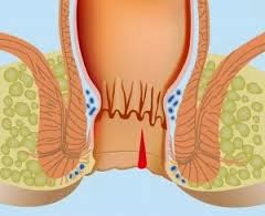 Thiết đồ cắt dọc vùng hậu môn nhìn thấy vết nứt phía sau.