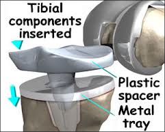 Khớp gối nhân tạo làm bằng plastic Khớp gối nhân tạo làm bằng plastic