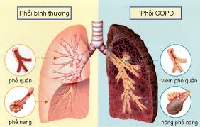 6. Cách phòng tránh và biện pháp bảo vệ phổi