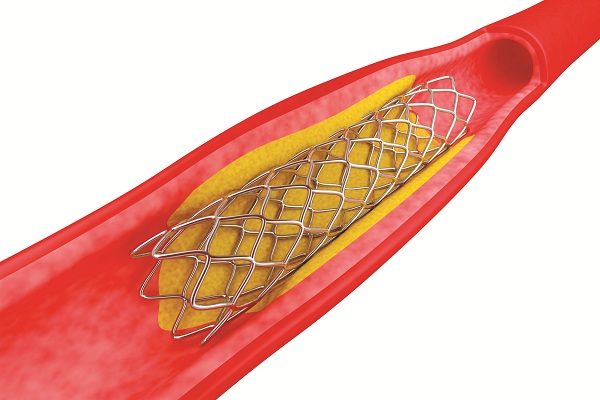 Đặt giá đỡ (stent) làm cho chỗ hẹp rộng ra, máu lưu thông dễ dàng