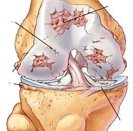 Tổn thương khớp gối do viêm khớp nhiễm khuẩn.