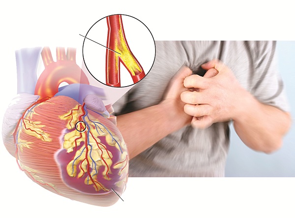 Bổ sung testosteron thời gian dài sẽ làm gia tăng sự hình thành các mảng xơ vữa ở động mạch vành