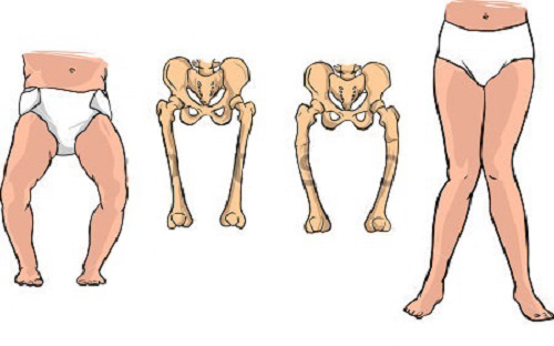 Biểu hiện của bệnh còi xương do thiếu canxi ở trẻ nhỏ