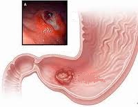 Tổn thương viêm loét dạ dày.