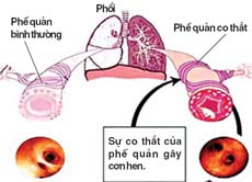 Bệnh hen là bệnh lý hô hấp rất phổ biến.