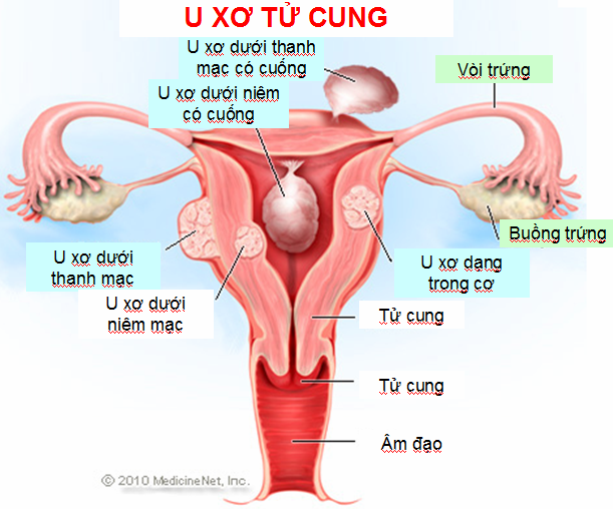 U xơ tử cung