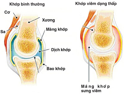 Viêm khớp. Ảnh minh họa: internet