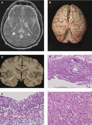 Viêm màng não: hình ảnh trên tiêu bản và phim chụp CT scanner.