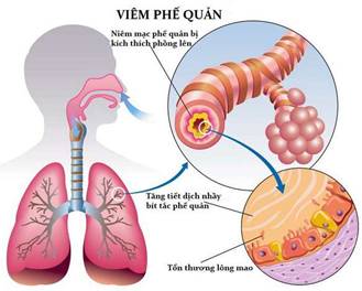 Tổn thương do viêm phế quản.