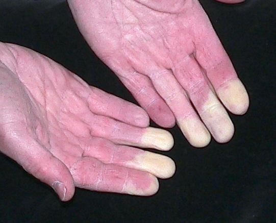 Tổn thương ngón tay trong bệnh Raynaud do rung chuyển.