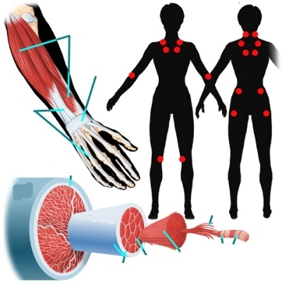 Sơ đồ các điểm đau trong bệnh đau xơ cơ.
