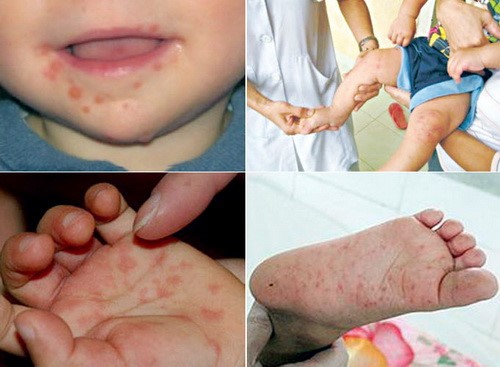Các dấu hiệu bệnh chân tay miệng.