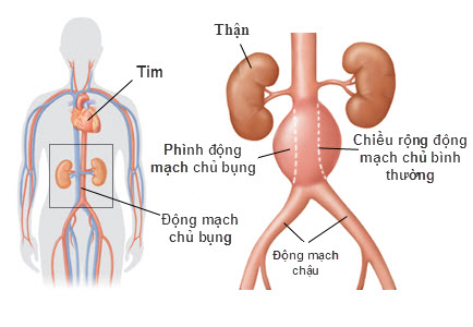 Phình động mạch chủ bụng. Ảnh minh họa: internet