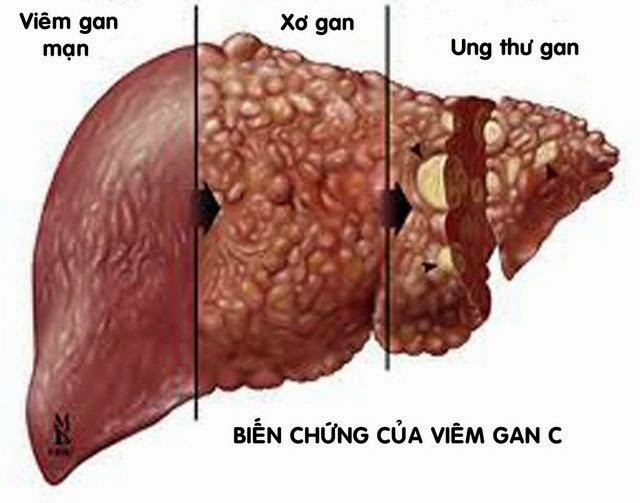 Nhiều bệnh nhân viêm gan đến viện thì bệnh đã ở giai đoạn muộn