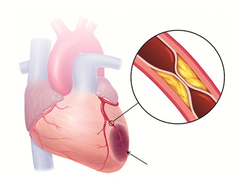 Nhồi máu cơ tim trong bệnh mạch vành.
