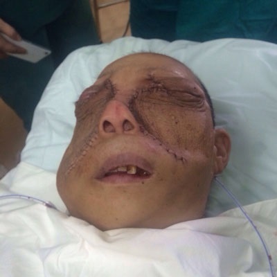 Bệnh nhân sau khi phẫu thuật.