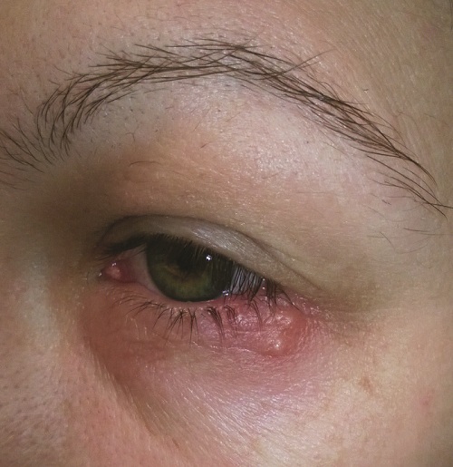 Vết thương do Herpes simples virút gây ra