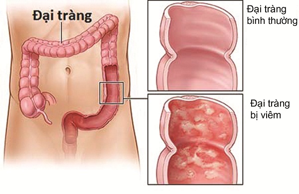 Viêm đại tràng mãn tính