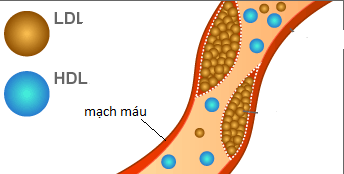 Cholesterol xấu LDL gây xơ vữa mạch máu (hình tròn nhỏ) và cholesterol tốt HDL (hình tròn to).