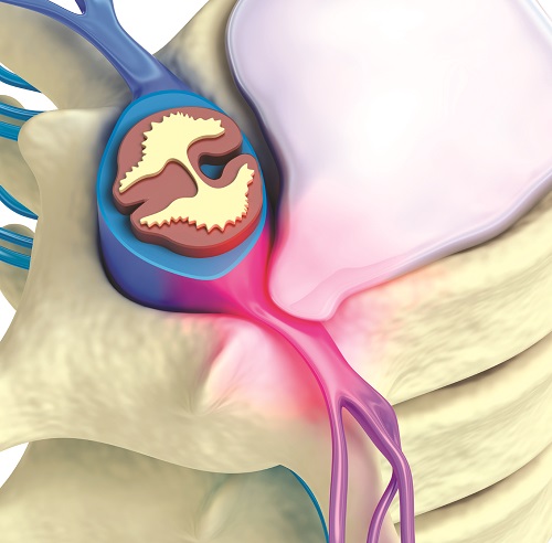Biến chứng đáng chú ý nhất là thoát vị đĩa đệm đốt sống cổ có chèn ép tủy sống