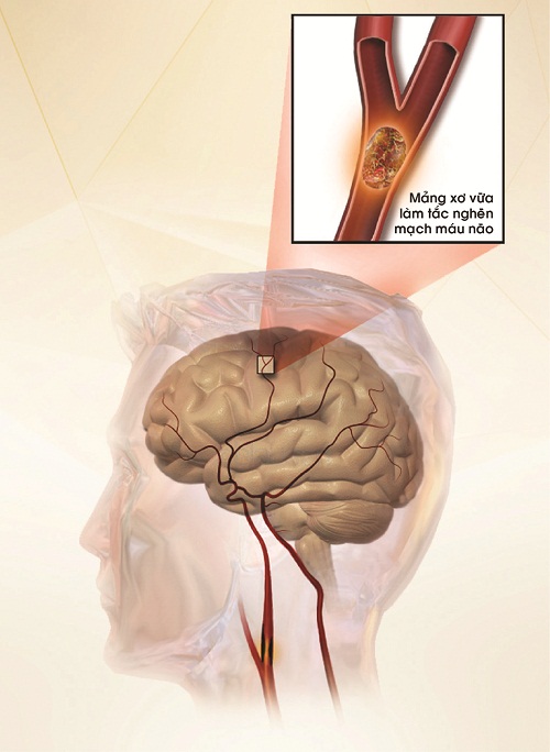 Mảng xơ vữa làm tắc nghẽn mạch máu não gây đột qụy