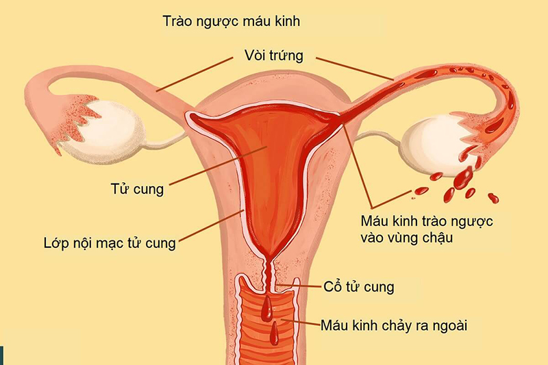 Lạc nội mạc tử cung: Nguyên nhân, biểu hiện và phương pháp điều trị - Ảnh 1.