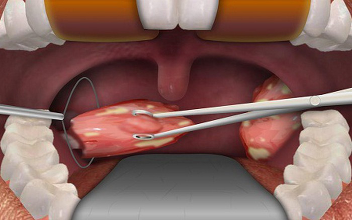 7 phương pháp đốt viêm họng hạt, cắt amidan hiệu quả, ít đau