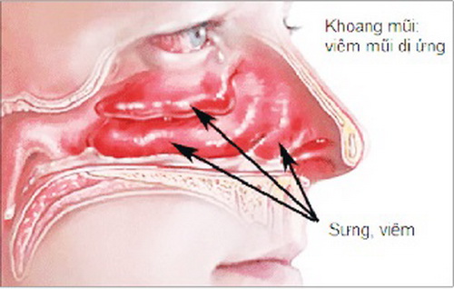 Điều trị viêm mũi dị ứng và lệch vách ngăn mũi - Ảnh 2.