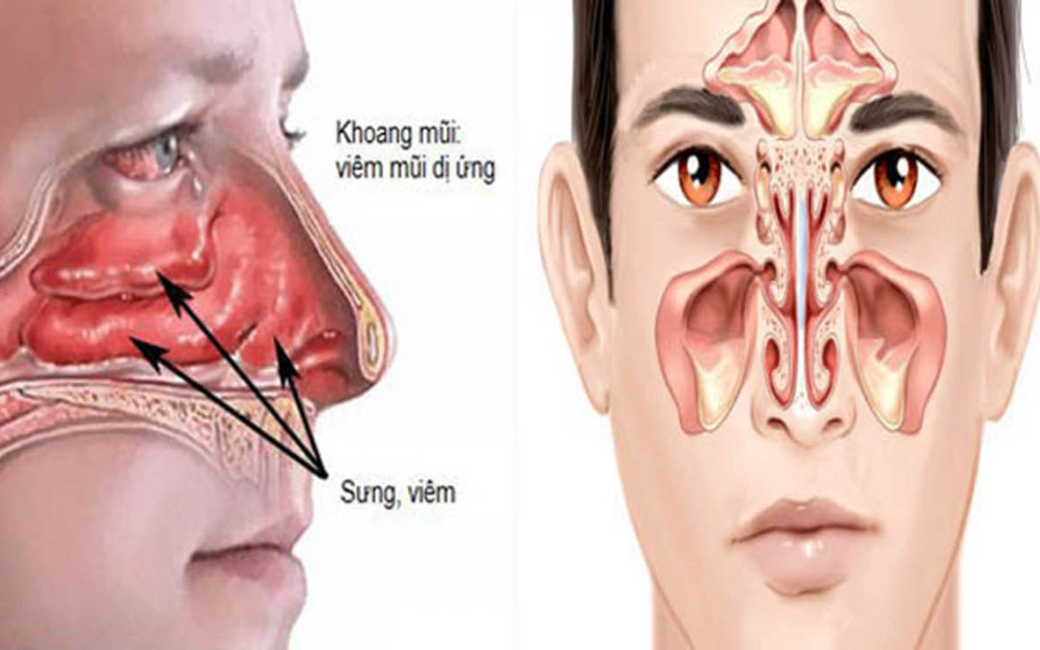 Cách phân biệt viêm xoang và viêm mũi dị ứng