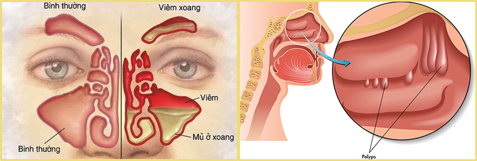 Viêm xoang – Polyp mũi: Các dấu hiệu và cách phân biệt - Ảnh 3.