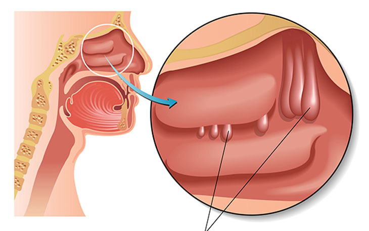 Viêm xoang – Polyp mũi: Các dấu hiệu và cách phân biệt