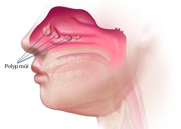 Viêm xoang – Polyp mũi: Các dấu hiệu và cách phân biệt - Ảnh 2.