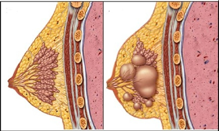 1. Tổng quan về xơ nang tuyến vú