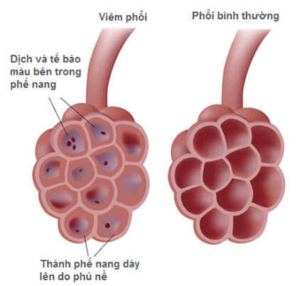 Những lưu ý để phòng bệnh viêm phổi cho trẻ trong mùa lạnh - Ảnh 5.