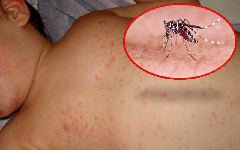 Cảnh giác với biến chứng của bệnh sốt xuất huyết Dengue 