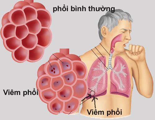 Viêm phổi ở người cao tuổi, nguyên nhân và cách phòng bệnh - Ảnh 3.