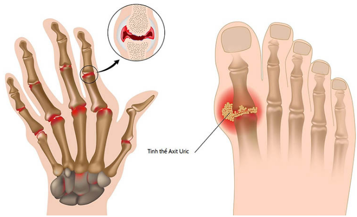 Thường xuyên ăn các món từ nước hầm xương, bé gái 7 tuổi mắc 'bệnh của người già' - Ảnh 1.