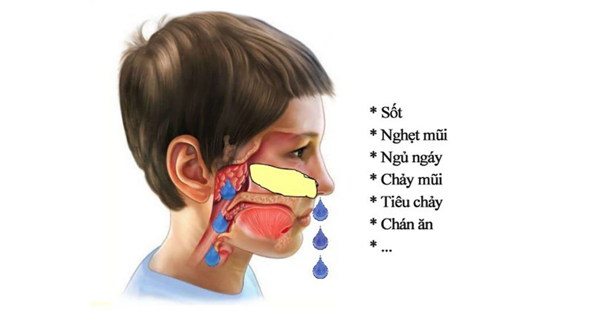 Bệnh viêm VA ở trẻ em - Những điều cha mẹ cần lưu ý - Ảnh 3.