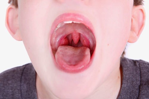 Trẻ bị viêm họng viêm amidan hoặc viêm xoang cần phải đưa trẻ đến cơ sở y tế có chuyên khoa tai mũi họng để điều trị triệt để