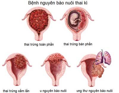 U50 gặp các dấu hiệu mang thai, đi khám mới biết mình chửa trứng  - Ảnh 1.