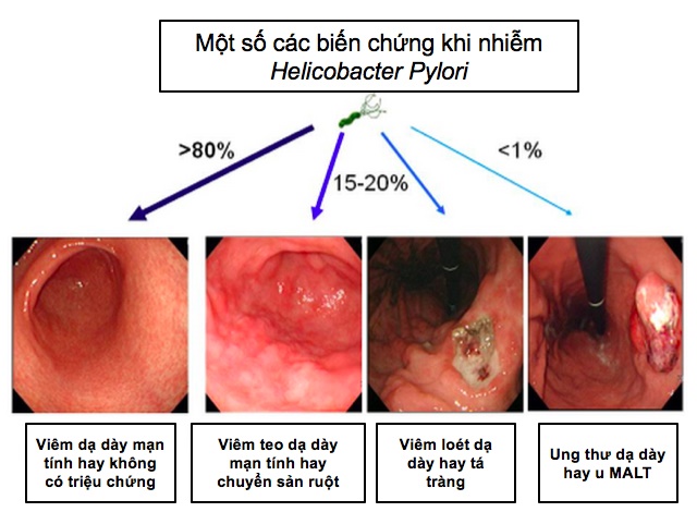 Diệt vi khuẩn H.P phòng ung thư dạ dày cần thiết hay không?