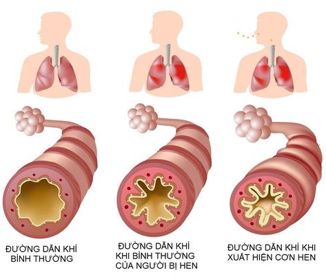 Hen suyễn: Bệnh hô hấp ở trẻ em nguy hiểm cần chữa trị sớm - Ảnh 6.