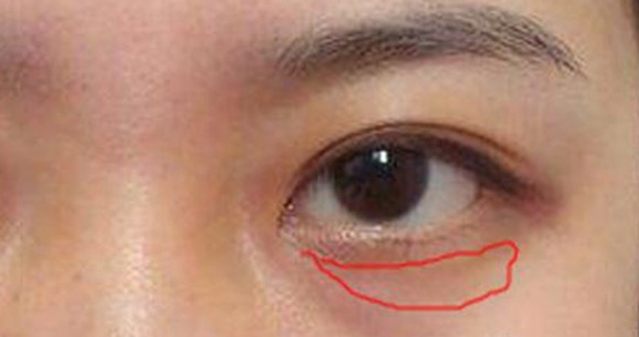 4 dấu hiệu trên khuôn mặt cho thấy nữ giới đang mắc bệnh phụ khoa