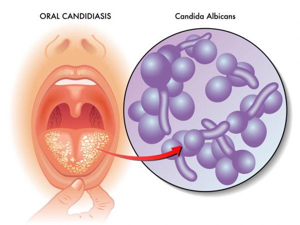 Dấu hiệu mắc bệnh nấm lưỡi và cách điều trị - Ảnh 3.