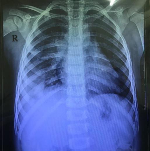 Tràn mủ màng phổi ở trẻ em: Nguyên nhân, triệu chứng và cách điều trị